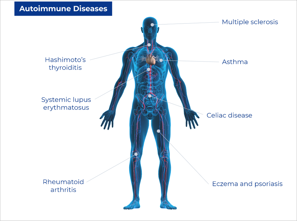 Systemic Autoimmune Rheumatic Diseases SARDS Diagnostics Grifols systemic-autoimmune-rheumatic-diseases-sards-diagnostics-grifols