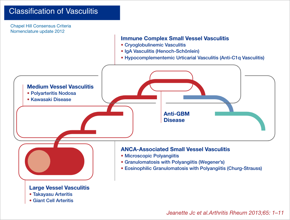 Vasculitis types and treatments grifols diagnostics