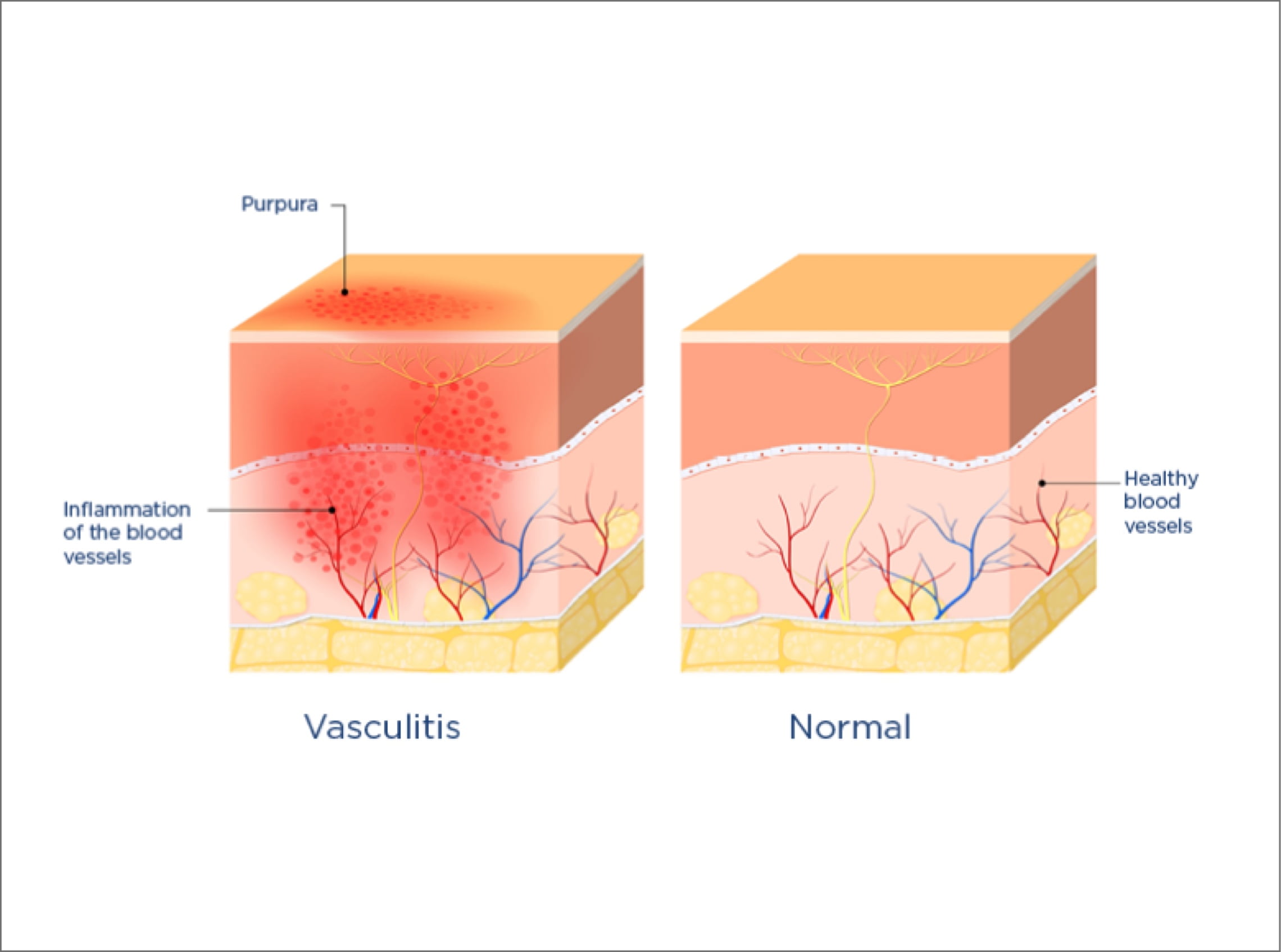 Vasculitis Types and Treatments
