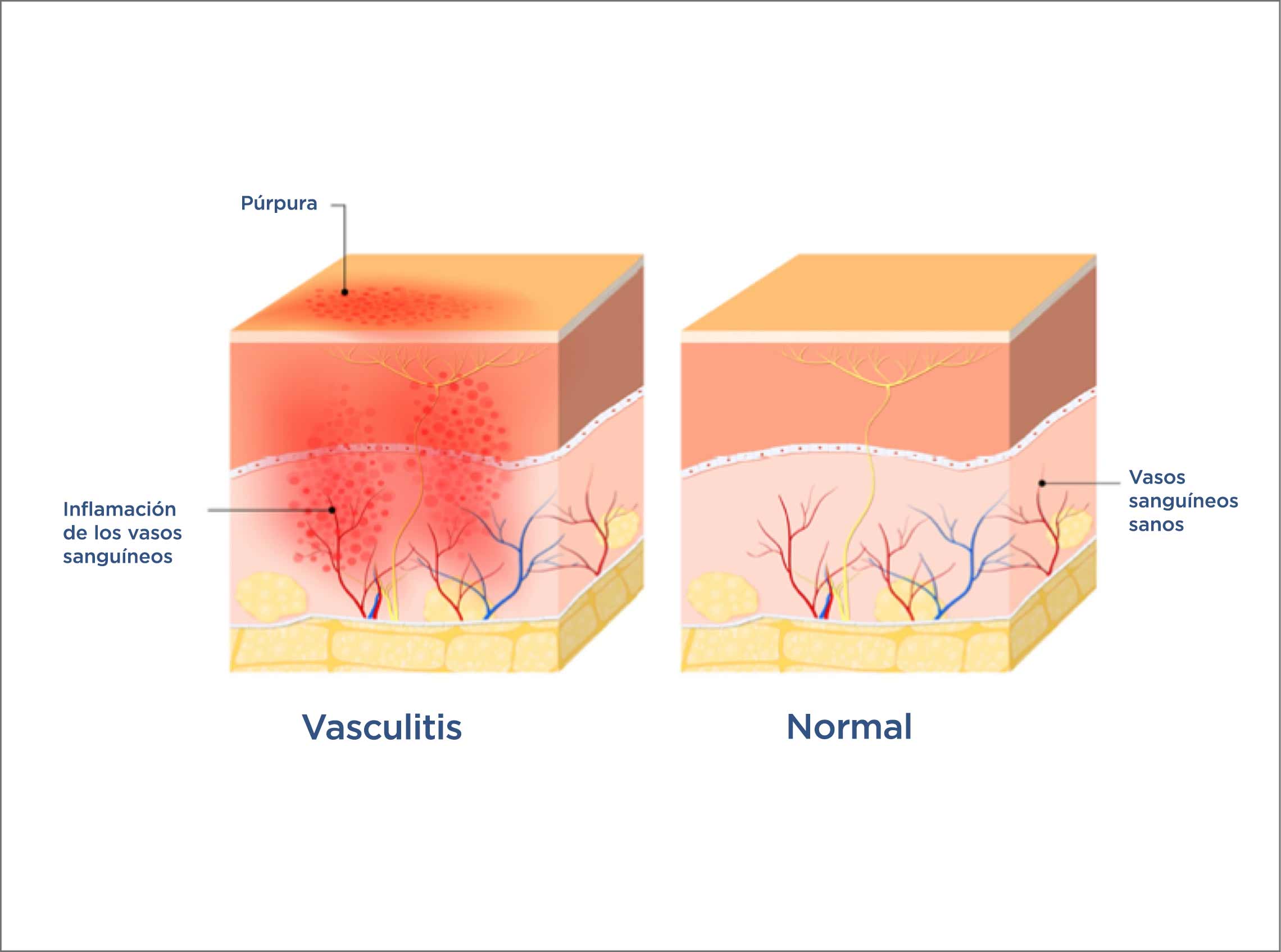 Tipos de vasculitis y sus tratamientos