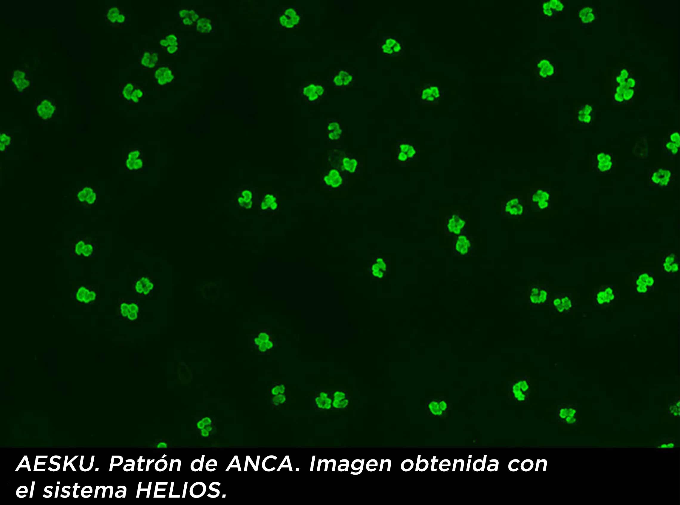 Por qué es importante el diagnóstico de las vasculitis