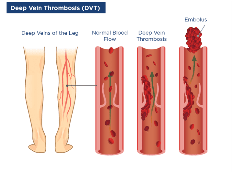 Deep Veln Thrombosis (DVT)