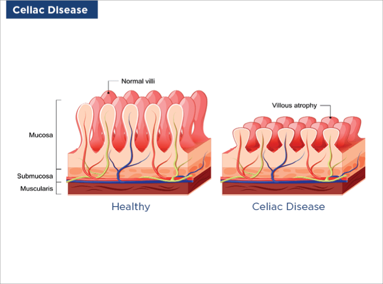 Etiology of Celiac Disease