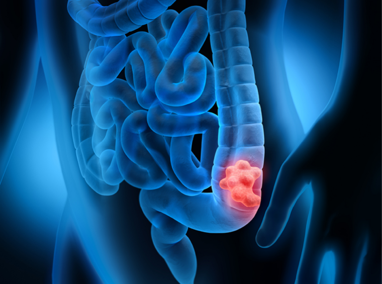 Inflammatory Bowel Disease